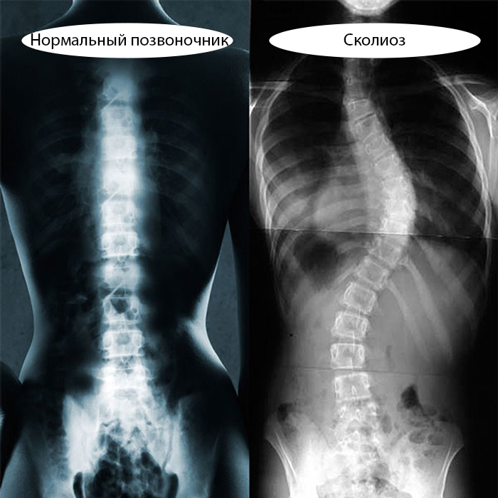 Льюис сейр лечение сколиоза фото