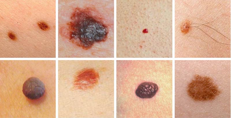 Симптомы рака кожи