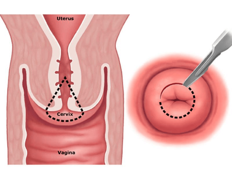 как проходит операция при раке матки