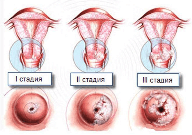 стадии рака матки с 1 стадии по 3ю стадию