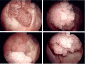 фото матки вид внутки органа / опухоли изнутри при раке влагалища